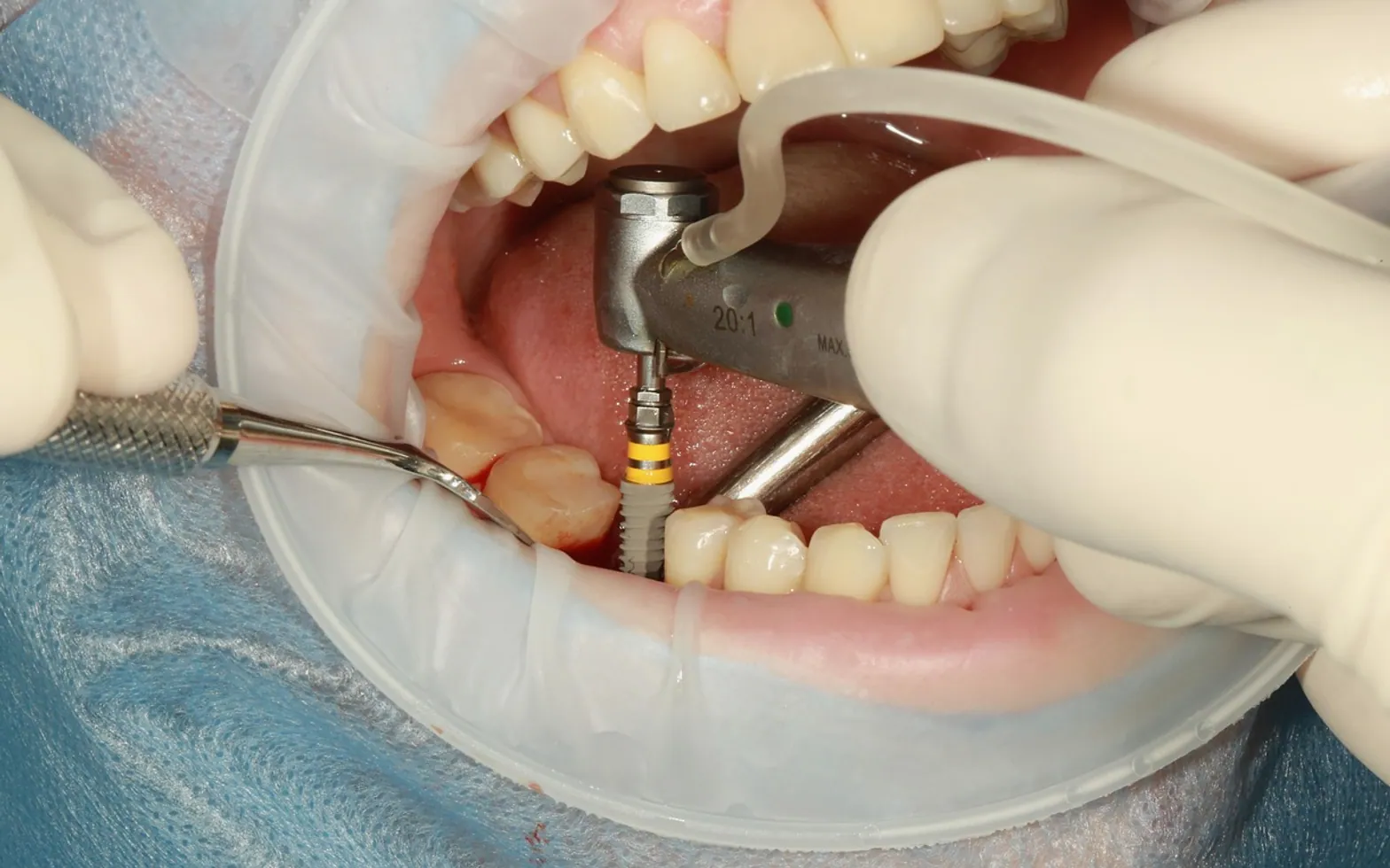 Dental, implant and surgery